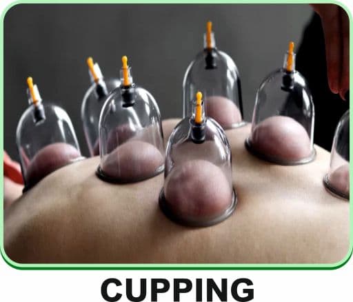 Image representing cupping therapy.